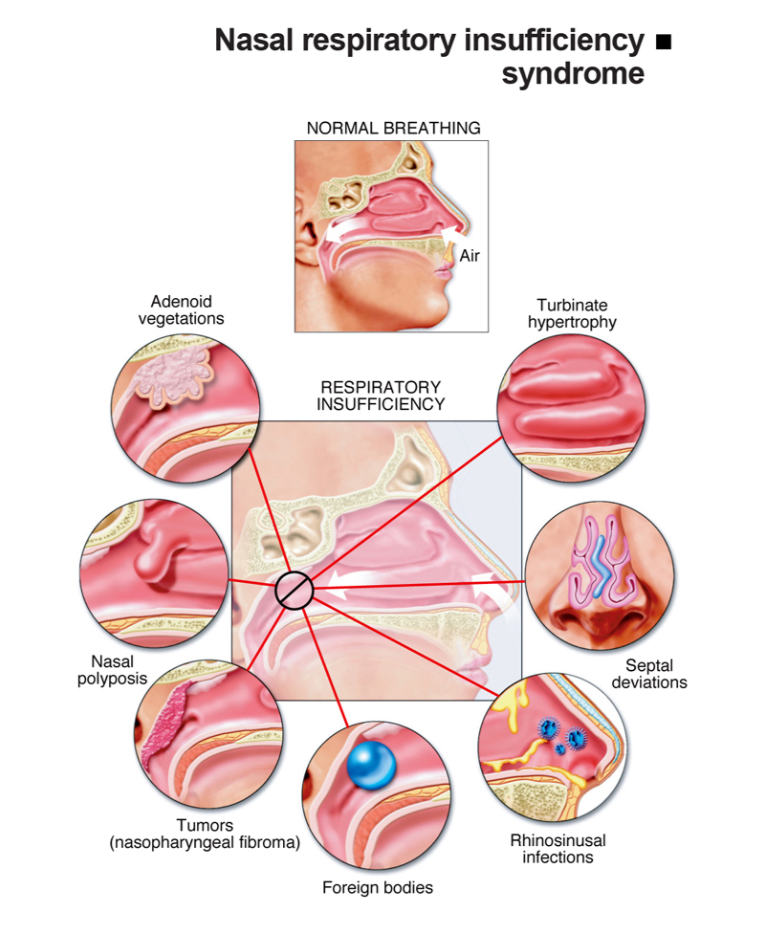 Infografis gangguan pernapasan hidung